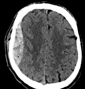Scan taken of my brain prior to neurosurger